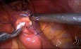 Laparoskopische subtotale Gastrektomie mit D2-Lymphonodektomie