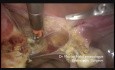 Subtotale laparoskopische Hysterektomie