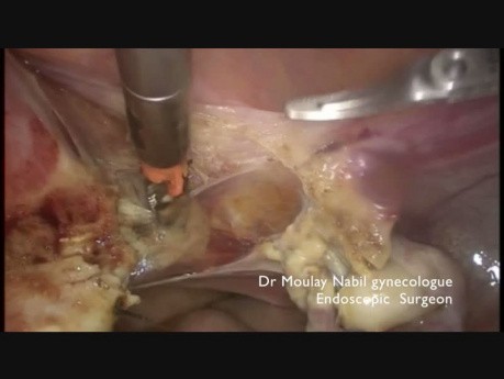 Subtotale laparoskopische Hysterektomie