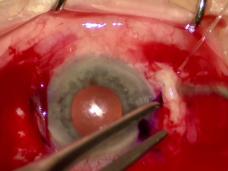 25G Pars-Plana-Vitrektomie + Soleko-Carlevale-IOL-Implantation unter Verwendung der „Sklerataschentechnik" (Scleral Pocket Technik)