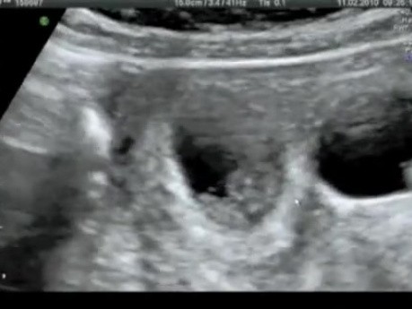 Transvaginale fetale Reduktion 