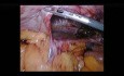 Laparoskopische Reparatur der großen Zwerchfellbruch