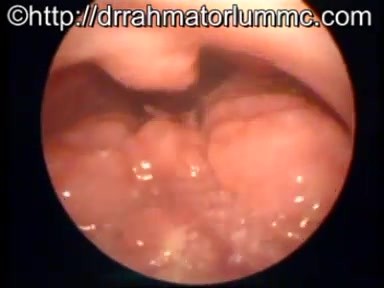 Linguale Tonsillitis - Ansammlungen von lymphatischem Gewebe