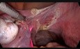 Totale laparoskopische Hysterektomie (mit der Ureterstentimplantation)