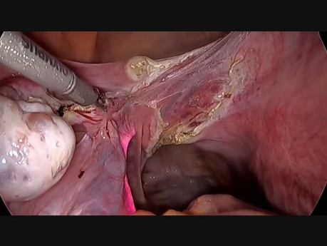 Totale laparoskopische Hysterektomie (mit der Ureterstentimplantation)