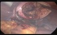 Resektohysteroskopie und Laparoskopie bei adenomatösen Polypen der Gebärmutterhöhle