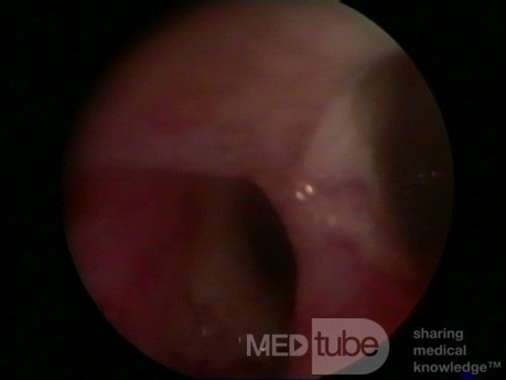 Uterus septus (Hysteroskopie)