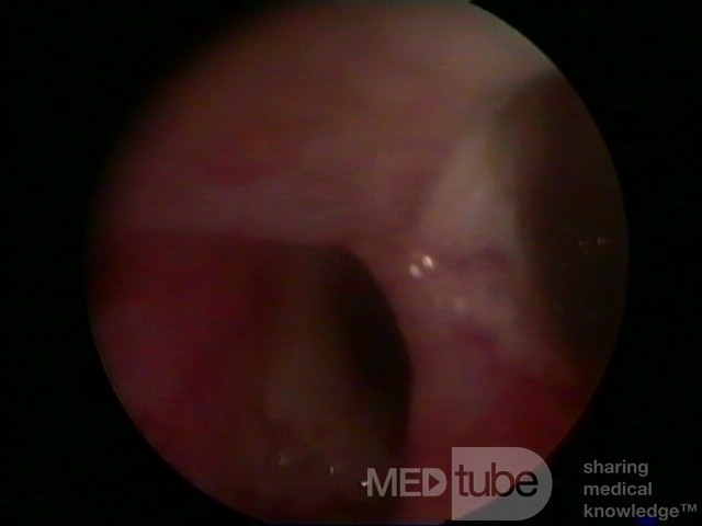 Uterus septus (Hysteroskopie)