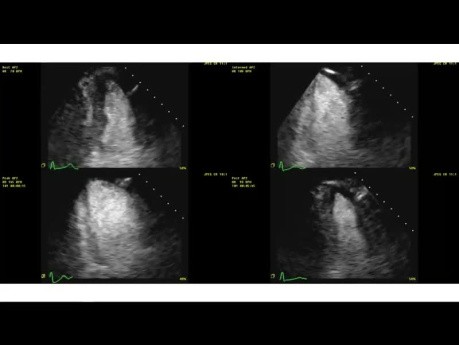 Stress-Echokardiographie: Grundlagen der Ischämiebewertung und klinische Fälle