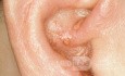 Herpes Zoster an der Ohrmuschel