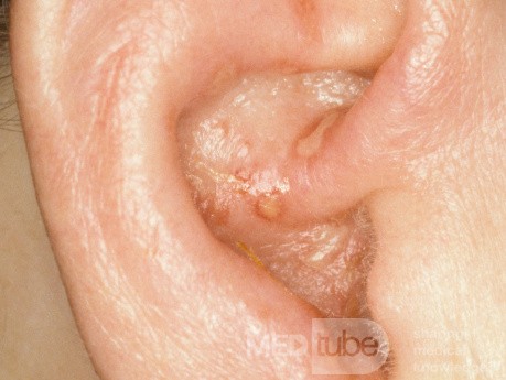 Herpes Zoster an der Ohrmuschel