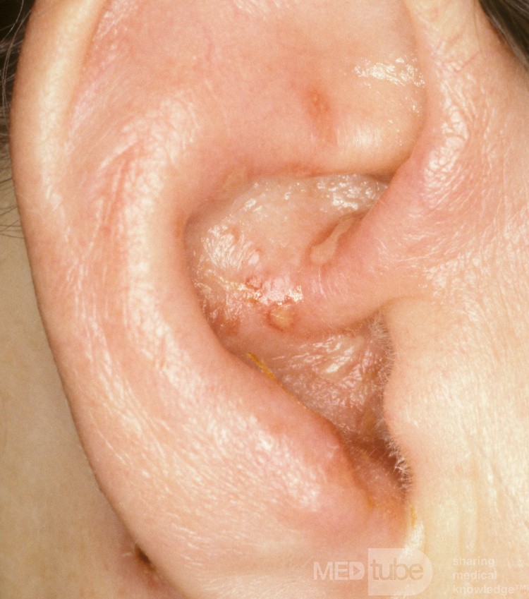 Herpes Zoster an der Ohrmuschel