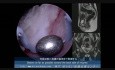 Hysteroskopische "Rollerball"-Technik zur Entfernung der Submukosa des Uterusfundus