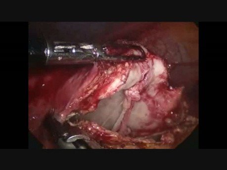 Laparoskopische Echinokokkenblasen Operation