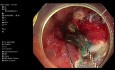 Endoskopische Resektion der Schleimhaut im Colon ascendens bei einem Patienten mit Morbus Crohn
