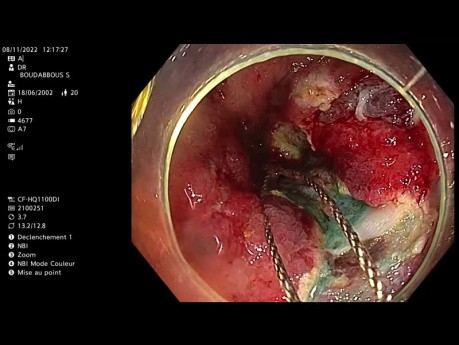 Endoskopische Resektion der Schleimhaut im Colon ascendens bei einem Patienten mit Morbus Crohn
