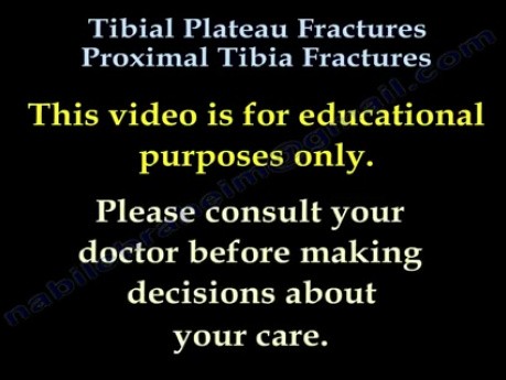 Proximale Tibiafrakturen - Klassifikation 