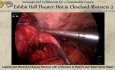 Laparoskopische Entfernung eines Band-over-Bypass mit GJ-Revision und Hiatushernienreparation