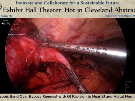 Laparoskopische Entfernung eines Band-over-Bypass mit GJ-Revision und Hiatushernienreparation