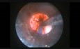 Endoskopische transglottische Tumorentfernung 2