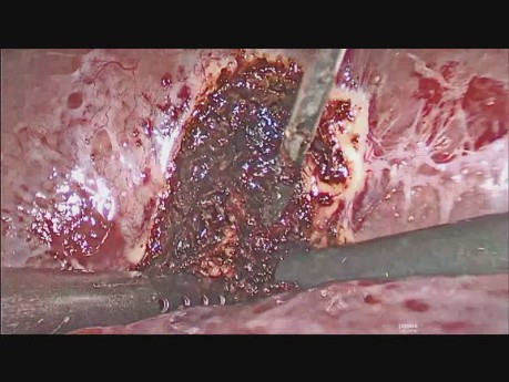 Laparoskopische Drainage des Leberabszesses