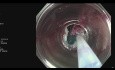 Dünndarmpolyp  - EMR (endoskopische Mukosaresektion)