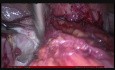 Totale laparoskopische Hysterektomie bei einer Patientin mit Endometriose (Stadium IV)