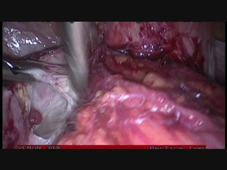 Totale laparoskopische Hysterektomie bei einer Patientin mit Endometriose (Stadium IV)