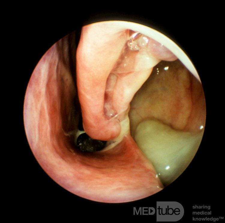 Antrostomie der unteren Meatus