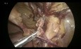 Laparoskopische Femoralhernienanatomie erklärt - TAPP