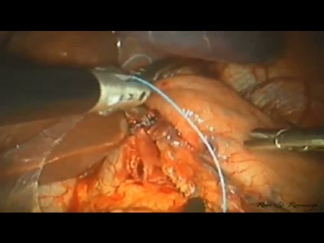 Konventionelle Laparoskopie zur laparoskopischen Einzelzugangchirurgie Heller-Myotomie bei Achalasie