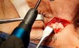 Osteom im nasoethmoidalen Bereich (2)