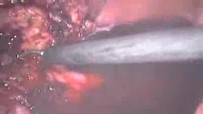 Laparoskopische subtotale Hysterektomie