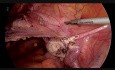Totale laparoskopische Hysterektomie mit Harnleiterschiene