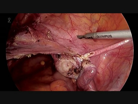 Totale laparoskopische Hysterektomie mit Harnleiterschiene