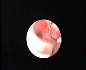 Hysteroskopische Endometriumablation