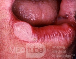 Plattenepithelkarzinom der Lippe