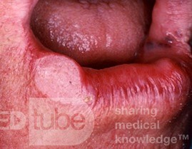 Plattenepithelkarzinom der Lippe