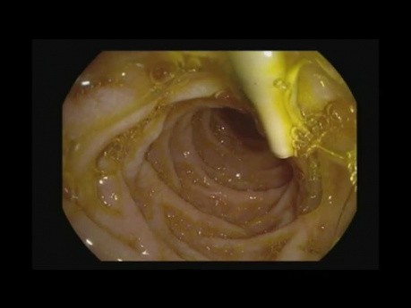 Entfernung des Stents des gemeinsamen Gallengangs
