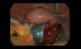Laparoskopische Zystektomie bei der Adnextorsion