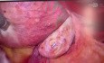 vNOTES Myomektomie
