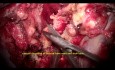 Großes Trigeminus-Schwannom, mikrochirurgische Operation der ophthalmischen Abteilung