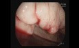 Nachblutung aus einer Krampfader im Fundus der Gebärmutter – Cyanacrylat + AB-Gel-Injektion
