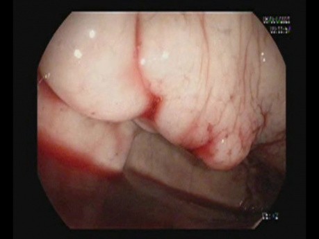 Nachblutung aus einer Krampfader im Fundus der Gebärmutter – Cyanacrylat + AB-Gel-Injektion