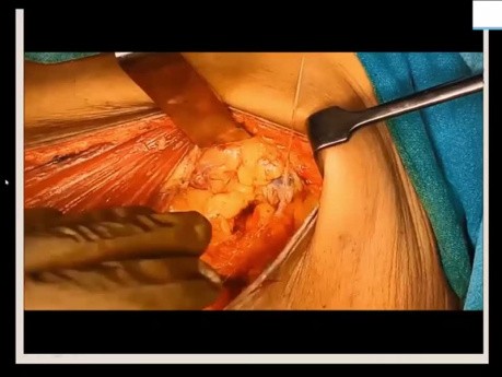 Geschichte der Brustkrebschirurgie (Reise von der verstümmelnden zur verschönernden Operation)