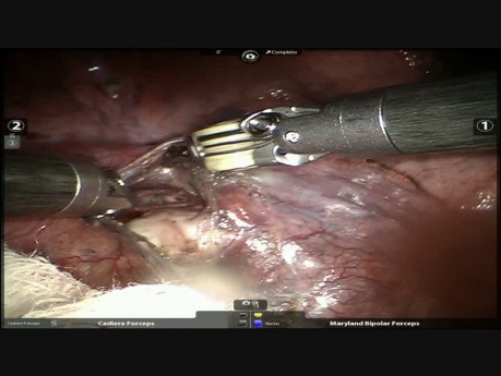 Roboterassistierte Lobektomie Unterlappen rechts