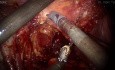 Hybride robotergestützte radikale Zystektomie mit intrakorporalem Conduit