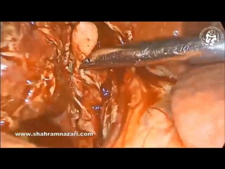 Laparoskopische Cholezystektomie bei gangränöser Cholezystitis