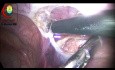 Abtrennung des Sacks von der Peritoneum in der Leistenhernie bei einem 7 Jahre alten Jungen mit gleichzeitiger ipsilateraler kommunizierender Hydrozele
