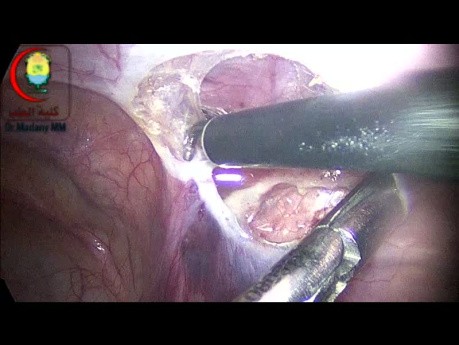 Abtrennung des Sacks von der Peritoneum in der Leistenhernie bei einem 7 Jahre alten Jungen mit gleichzeitiger ipsilateraler kommunizierender Hydrozele
